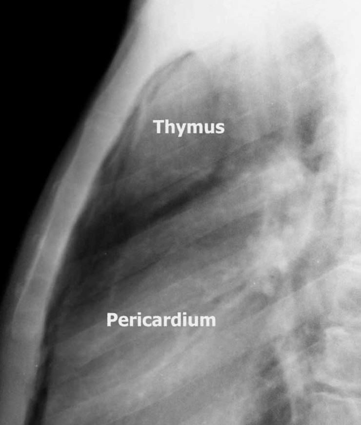 syndrome 네이버 블로그