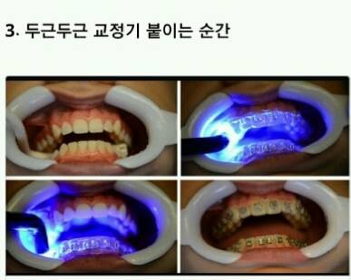 치아교정의 고통 ㄷㄷㄷ.jpg | 인스티즈