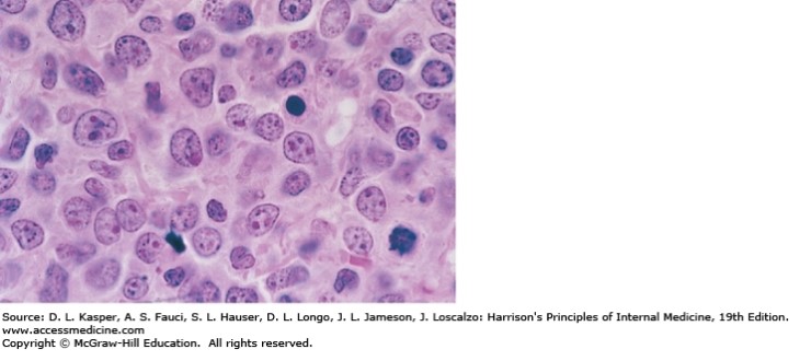 미만성 거대B세포 림프종, Diffuse Large BCell Lymphoma (해리슨 19판