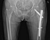 orif intertrochanteric fracture orif intertrochanteric fracture